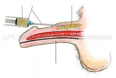 διεύρυνση πέους με ένεση